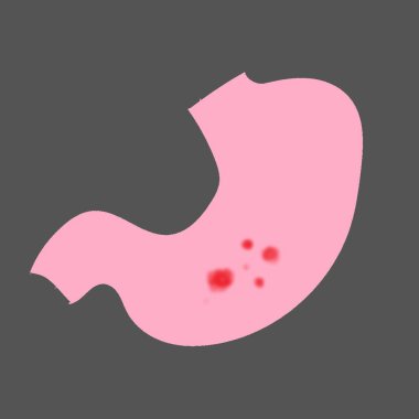 Mide ülseri illüstrasyonu eğitim ve sağlık sektörü projeleri için yararlı