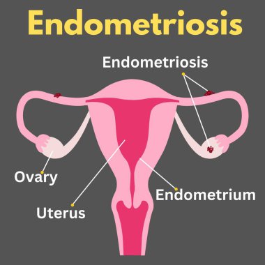 Endometriyozis uterus hastalığı kadın üreme hastalığı illüstrasyonu sağlık sektörü için yararlı