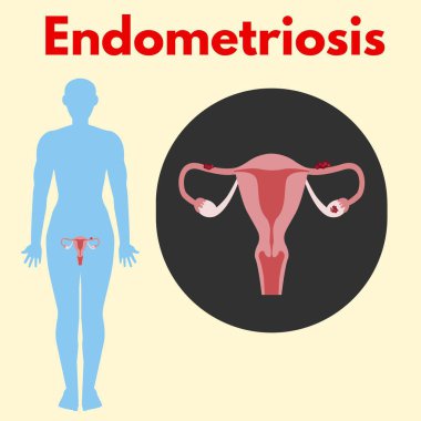 Vücut uterusundan yakınlaşan endometriyozis kadın üreme hastalığı illüstrasyonu sağlık sektörü için yararlı