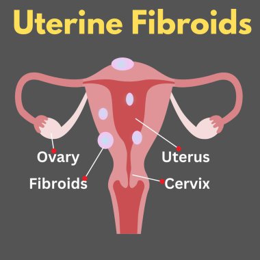 rahim fibroidi hastası kadın üreme hastalığı illüstrasyonu sağlık sektörü için yararlı