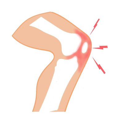 diz ağrısı iltihaplanma illüstrasyon kırmızılık şişme tasarım bilimi 