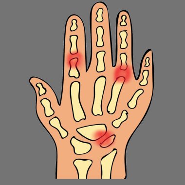 El kırmızılığı iltihabı konsepti sağlık sektörü için faydalı - 1