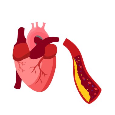 Plak kolesterolden kaynaklanan kan tıkanıklığı.