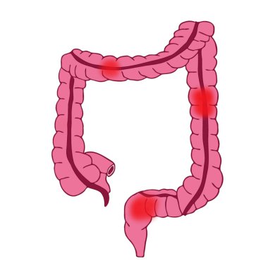 İnflamasyon kırmızısı kalın bağırsak bağırsak illüstrasyonunda ağrı.