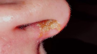 Burnun altında deri enfeksiyonu ya da tahriş sonucu oluşan sarımsı kabuk ve iltihaplanma var. Tıbbi ya da dermatolojik kavram.