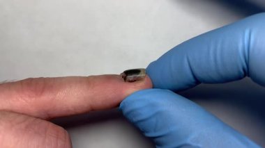 Eldivenli bir elin yakın çekimi. Beyaz arka planda koyu renk hematom olan çürük bir tırnağı inceliyor..