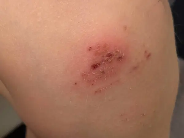 Yaralı dizine yakın plan, taze yara ve derisinde sıyrıklar var.. 