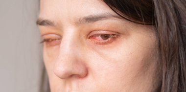 Bir insanın gözünün yakın görüntüsü konjonktivit belirtileri gösteriyor. Dikkat çekici bir kızarıklık ve tahriş. Arkaplan tarafsız, etkilenen gözün durumunu vurguluyor..