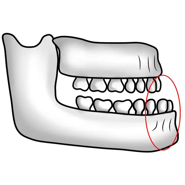 Alt çenesi çıkıntılı anormal çene yapısı bir alt ısırığa neden olur