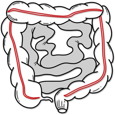 İnsan bağırsağının kırmızı ve siyah çizgileri.