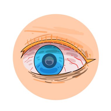 Beyazlarda ve sklerada gözle görülür tahriş ve kızarıklık olan kırmızı gözlere yakın çekim. Genellikle yorgunluk, alerji ya da kuraklıktan kaynaklanır. Kızarıklık hafif ya da yoğun olabilir, rahatsızlık veya duygusal bir duruma dikkat çeker.. 