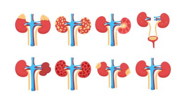 Farklı türde böbrek hastalıkları koleksiyonu, sağlıklı, polisistik, böbrek taşı, enfeksiyon, kronik hastalık, hidronefroz, tümör gibi durumlarda insan iç organları sorunu.