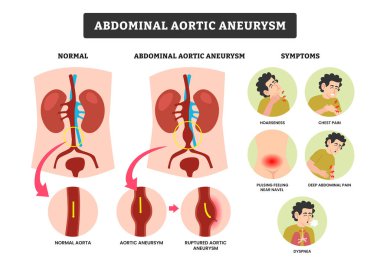 Abdominal Aort Anevrizması, semptomları tıbbi poster bilgisi, torasik ve karın ağrısı. Abdominal atardamar dolaşım sistemi. Abdominal aort ve anevrizmalı torasik aort..