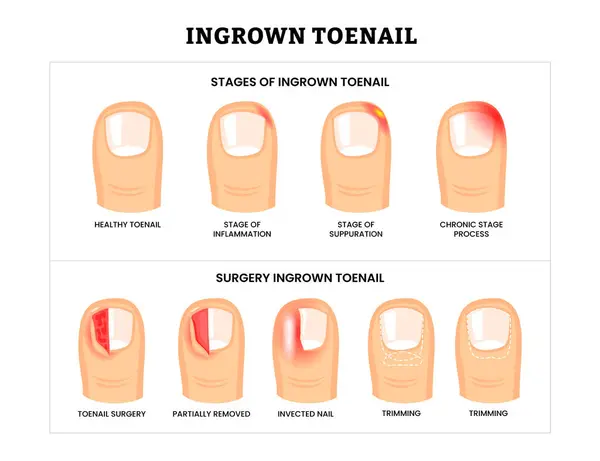 İndirilmiş ayak tırnağı koleksiyonu, küçültülmüş ayak tırnağı aşamaları ve ameliyat bilgilerine sahip, kısmen çıkarılmış tırnak, ayak hastalıkları, enfekte olmuş tırnak ve tırnak törpüleme türleri, beyaz arka planda izole edilmiş..
