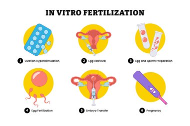 Vitro Fertilizasyon basamaklarında bilgi ve poster tasarımı, tıbbi illüstrasyon. Etiketli yumurtalık hiperstimülasyonu, yumurta alımı, yumurta ve sperm hazırlığı, yumurta döllenmesi, embriyo transferi.