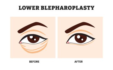 Estetik ameliyattan önce ve sonra düşük Blepharoplasty, Eyelid Rejuvenation için Kozmetik Göz Cerrahisi, Buruşuk Buruşukluk Temizleme, vektör ilüstrasyonları.