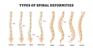 Farklı tipte omurilik bozuklukları, eğitim tıbbi poster tasarımı sağlık hizmetleri etiketli torasik, torakolumbar, bel, çift eğri, normal, kifoz, lordosis, düz sırt..
