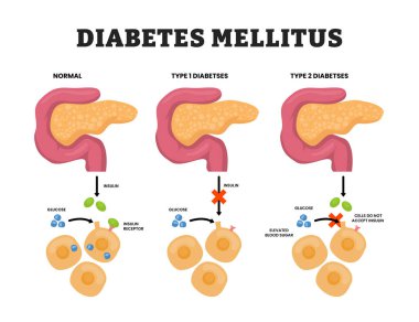 Tip 1 diyabet ve tip 2 diyabet, pankreas anatomi diyabeti, mellitus türleri, eğitim tıbbi poster sağlık hizmetleri şeması, normal ve hasarlı pankreas etiketleri arasındaki fark.