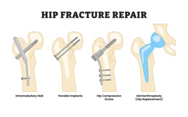 Farklı kalça kırığı tamir türleri, eğitim amaçlı tıbbi poster tasarımı sağlık hizmetleri etiketli intrameduller çivi, paralel implant, kalça sıkıştırma vidası, hemiartroplasti. Kemik Kırığı