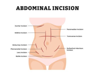 Kadınlar için Abdominal Kesim, eğitim tıbbi poster tasarımı sağlık sistemi, Tıbbi İşlem, Anatomi, Laparotomi, Cerrahi Eğitim için Abdomen 'de Cerrahi Kesik etiketi