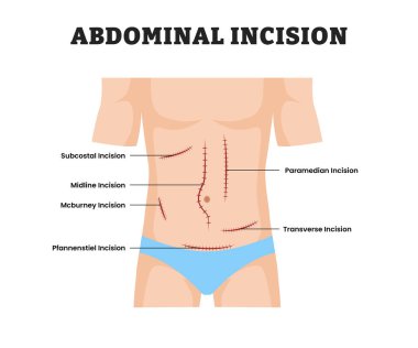 İnsan için Abdominal Kesim, eğitim tıbbi poster tasarımı sağlık sistemi, Tıbbi İşlem, Anatomi, Laparotomi, Cerrahi Eğitim için Abdomen 'de Cerrahi Kesik etiketi