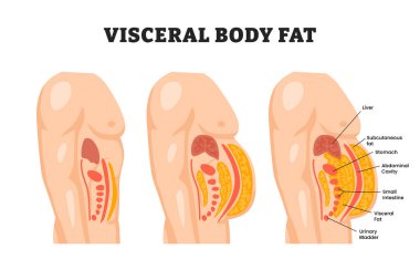İç yağlar, eğitici tıbbi poster tasarımı sağlık sistemi etiketli karın boşluğunun iç kapılarını kaplıyor. Aşırı kilolu hastalık konsepti, kilo kaybı, yağ aldırma, diyet.