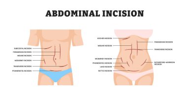 Kadın ve erkek için abdominal kesim, eğitim tıbbi poster tasarımı sağlık hizmetleri şeması, Tıbbi İşlem, Anatomi, Laparotomi, Cerrahi Eğitim için Abdomen 'de Cerrahi Kesik etiketi