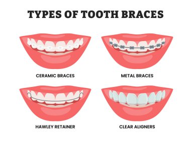 Farklı diş telleri, eğitim amaçlı tıbbi poster tasarımı sağlık hizmetleri etiketli seramik teller, metal teller, Hawley diş teli ve net hizalayıcı. Diş dudağı, ortodontik dişçi.