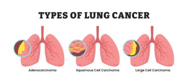 Farklı akciğer kanseri tipleri, eğitici tıbbi poster tasarımı sağlık hizmetleri şeması, etiketli adenokarsinom, skuamöz hücre kanseri ve büyük hücre kanseri. Solunum sistemi hastalığı.