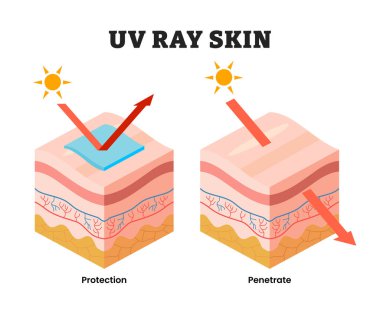 Güneş kremi ile ve güneş kremi olmadan insan derisi, eğitici tıbbi poster tasarımı sağlık hizmetleri şeması, UV cilt koruması etiketi. Hasarlı insan derisi güneşten önce ve sonra soyulur..