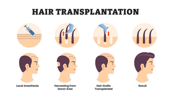 Stages of hair transplantation surgical procedure stages, educational medical poster design healthcare scheme, labeled removes hair follicles from one part of the body, local anesthesia, hair grafts.