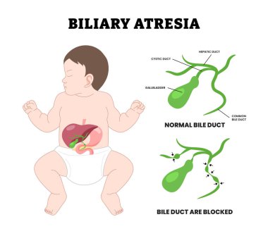 Bebek Biliary atrezi safra kanalı tıkanmış, eğitim amaçlı tıbbi poster tasarımı sağlık hizmetleri, birincil akut koledochal kist taş engelleyici engelleyici bilirubin seviyesi asidi bloke etmiş. Ekstrahepatik ductopenia.
