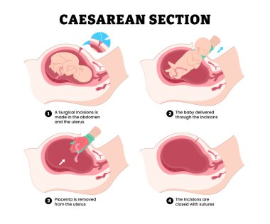 Sezaryen bölümü sezaryen basamakları, eğitim tıbbi poster tasarımı sağlık hizmetleri, etiketli cerrahi kesik, bebek doğumu, rahimdeki plasentayı çıkarma, kapalı dikiş..