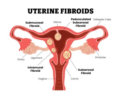 Rahim fibroidleri, rahim leyomları veya miyomlar, kadın üreme sistemi, eğitim tıbbi poster tasarımı sağlık hizmetleri şeması, etiketli iç organlar rahim ağzı, kısırlık sorunu.