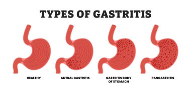 Farklı gastrit tipleri, eğitici tıbbi poster tasarımı sağlık hizmeti şeması, insan mide iç organları. Etiket iltihabı, antral gastrit, pangastrit, mide iltihabı..