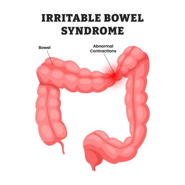 Sinirli Bağırsak Sendromu, eğitici tıbbi poster tasarımı sağlık hizmetleri, insan mide iç organları. Etiketli gastrointestinal bozukluk, kolon, bağırsak, kalın bağırsak.
