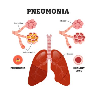 Sağlıklı vs zatürree akciğer farkı, eğitici tıbbi poster tasarımı sağlık hizmetleri şeması, insan akciğer hastalıkları iç organları. Etiketlenmiş bronşit iltihabı, bakterilerin sebep olduğu alveoller..