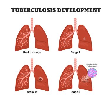 Tüberküloz Gelişim Evresi Diyagram Süreci, eğitim tıbbi poster tasarımı sağlık hizmetleri şeması, insan akciğer hastalıkları iç organları. Etiketli Mycobacterium Tüberküloz Bakterisi.