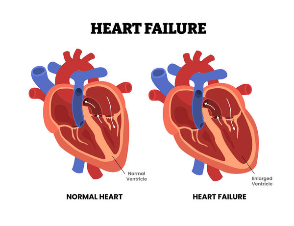 Heart failure, educational medical poster design healthcare scheme, internal organs, cardiovascular disease, heart complication. Labeled enlarged ventricle. Diastolic Dysfunction preserved ejection.