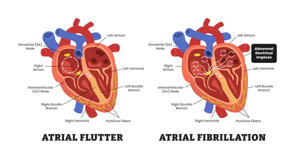Heart Atrial Fibrillation vS Atrial Flutter, eğitim amaçlı tıbbi poster tasarımı sağlık hizmetleri, iç organlar, kardiyovasküler hastalıklar, kalp komplikasyonu. Etiketlenmiş anormal elektrik itici güç.