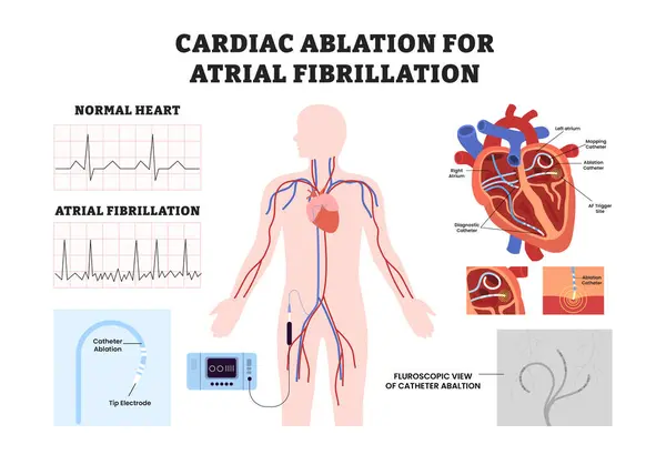 Kalp atriyal fibrilasyonu için kardiyak ablasyon, eğitim amaçlı tıbbi poster tasarımı sağlık hizmeti şeması, iç organlar. Etiketli ablasyon kateteri, düzensiz kalp ritmi EKG, floroskopik.