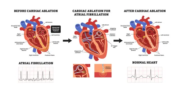 Kalp atriyal fibrilasyonu için önce ve sonra ablasyon, eğitim amaçlı tıbbi poster tasarımı sağlık hizmeti şeması, iç organlar. Etiketli ablasyon katateri, düzensiz kalp ritmi EKG.