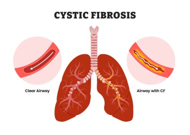 Kistik Fibroz, eğitim amaçlı tıbbi poster tasarımı sağlık hizmetleri, insan akciğer hastalıkları iç organları. Solunum yolu kistik fibrozis ile hava yolu açık. Bronşiektazi akciğerleri.