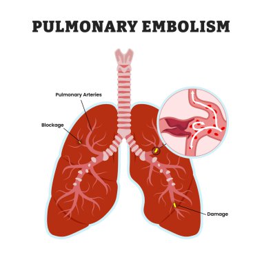 Pulmoner embolizm ciğerler, eğitim amaçlı tıbbi poster tasarımı sağlık hizmeti şeması, insan akciğer hastalıkları iç organları. Etiketlenmiş kan pıhtısını engellemiş ya da akciğerlerdeki hasarlı arteri tıkamış..