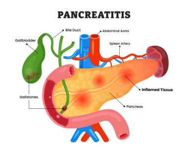 Pankreas iltihabı veya pankreas iltihabı, eğitim amaçlı tıbbi poster tasarımı sağlık hizmeti şeması, pankreas hastalığı iç organları. Safra kesesi taşı, iltihaplı doku, safra kanalı.
