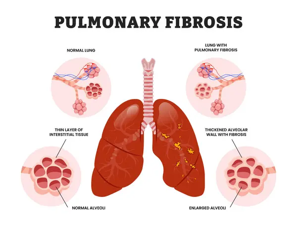 Pulmoner fibrozis, pulmoner, fibrozis, fibrozis, interstitial lung disease, interstitial, anatomy, human, internal, organ, part, lung, lungs, respiratory, system, trachea, respiation, bro