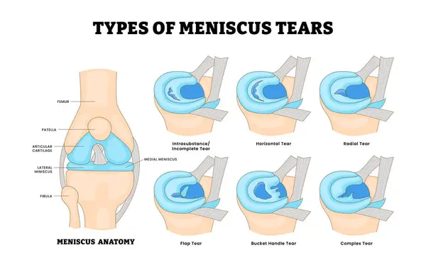 Farklı menisküs gözyaşı tipleri, meniskal yaralanma, eğitim tıbbi poster tasarımı sağlık hizmetleri, Meniscus, Tear, Bucket, Handle, Complex, Flap, Yatay, Intrasubstance, Tamamlanmamış.