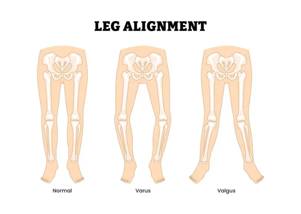 Farklı bacak hizalama tipleri, eğitim tıbbi poster tasarımı sağlık hizmeti şeması, etiketli Normal Bacak, Valgus Bacak Hizalama, Varus Bacak Hizalama, ortopedik sorunlar, iskelet deformasyonları.