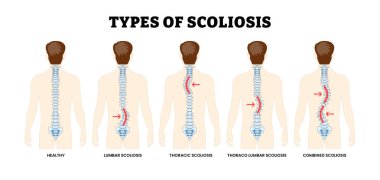 Skolyoz tiplerinin farklı türleri. Omurga Bozukluğu veya Deformasyon Yanlış Omurga Hizalaması, Eğitimsel Tıbbi Poster Tasarımı Sağlık Şeması, Etiketli Lumbar, Thoracic, Thoracolumbar, Birleşik.