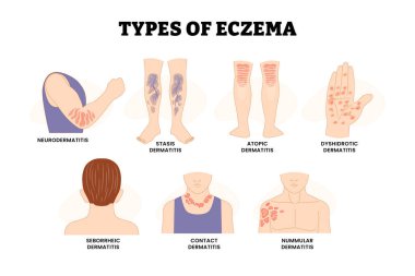 Dermatit ya da Egzama Tipi Kıymık, İltihaplı Cilt, Dermatoloji, Eğitim Tıbbi Poster Tasarımı Sağlık Şeması, Kontak, Disidotik, Nörodermatit, Nummular, Seborrheic, Stasis.